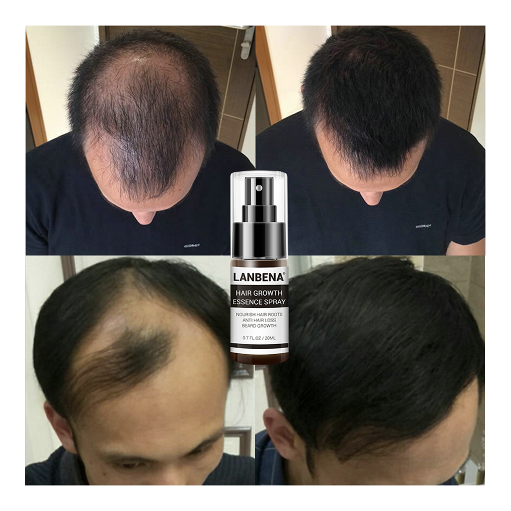 LANBENA 20ml saç büyüme özü sp - Hair Care Essence Oil Spray incelemesi ve fiyatı